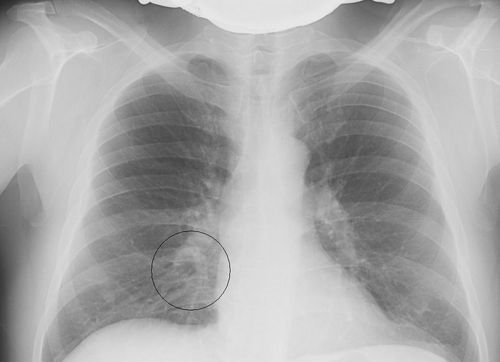 Пациентам с подозрением на COVID-19 компьютерную томографию и рентген будут делать бесплатно