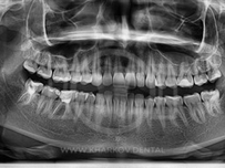 Ортопантомография в Киеве - суть и преимущества процедуры диагностики